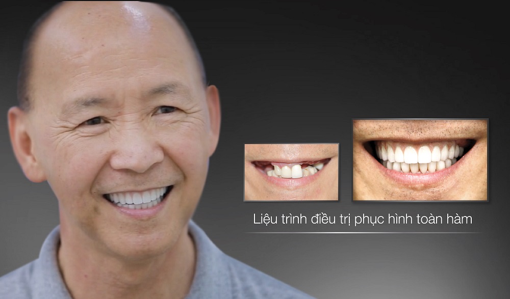 Cựu y tá 66 tuổi và bí mật khó ngờ trong hàm răng